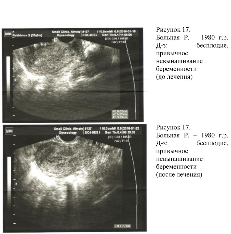 Эндометрий толщина при беременности. УЗИ нормального эндометрия. Гравидарный эндометрий на УЗИ. Гипоплазия эндометрия на УЗИ. Трехслойная структура эндометрия (УЗИ).