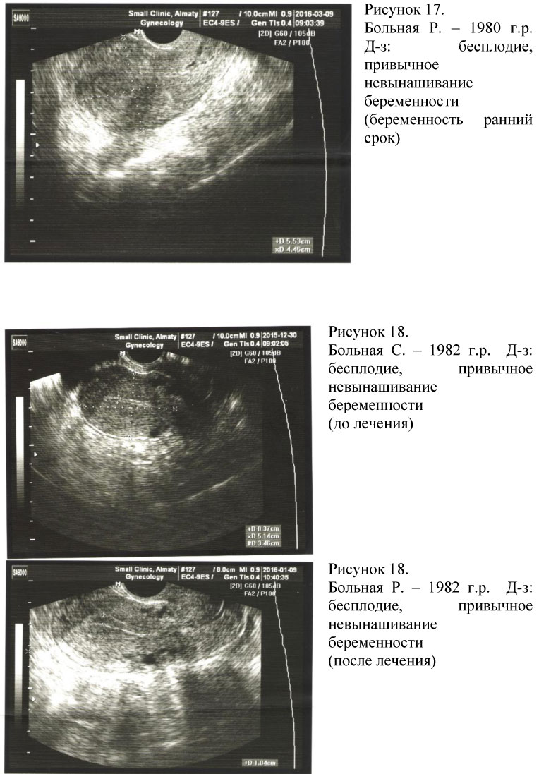Эндометрий толщина при беременности. УЗИ беременности 5 недель эндометрий. Трансвагинальное УЗИ эндометрия. Эндометрий на УЗИ при беременности.